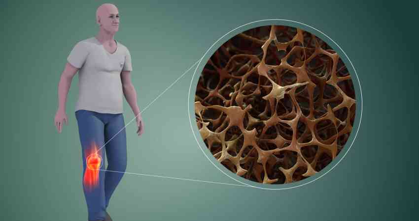 Cara Mencegah & Mengobati Osteoporosis